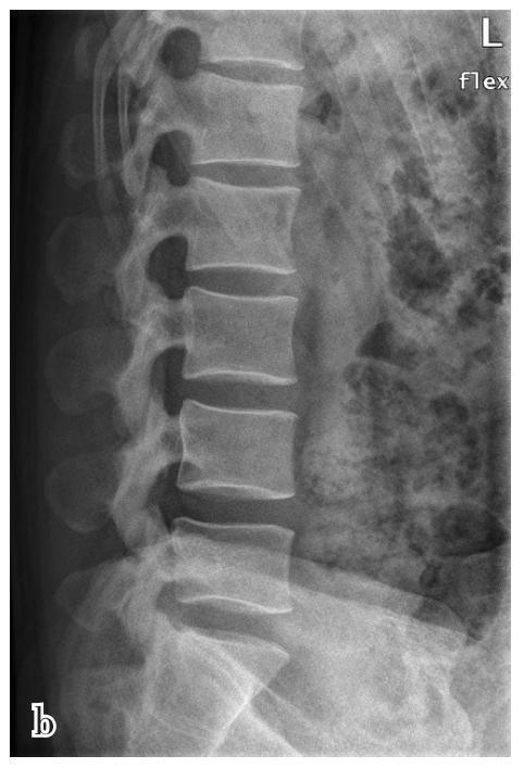 图2-1-6 腰椎斜位片
