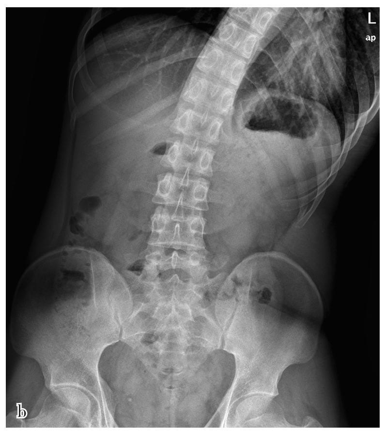 下端骶骨中间的骶骨裂隙影,骶骨下切迹轮廓,骶骨与尾骨交界骶尾关节处