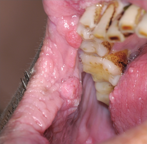 图3-6 黑棘皮病——右口角黏膜乳头瘤样增生