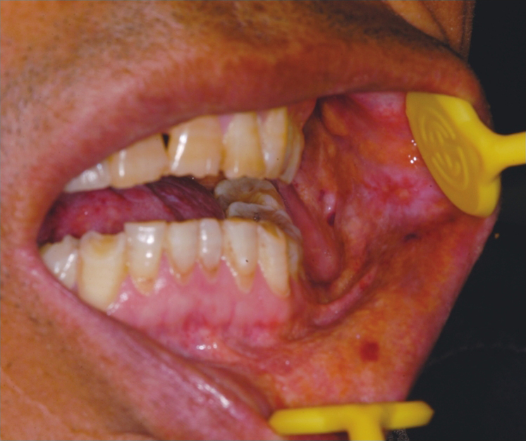 口腔检查:张口中度受限,下唇黏膜下见黄白色颗粒结节样沉积物