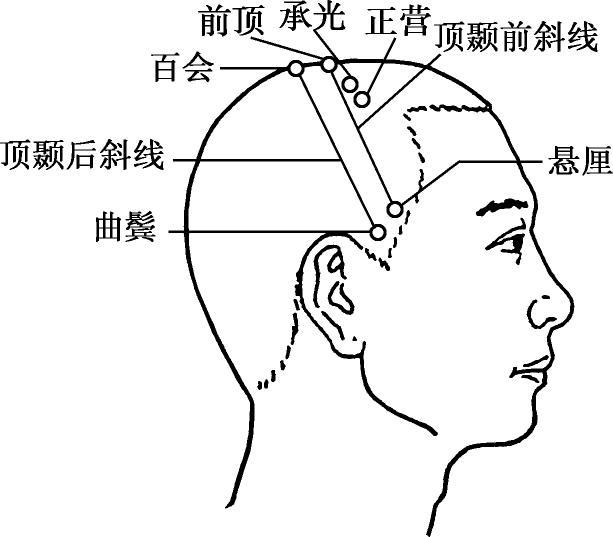 顶颞前斜线 定位:在头部侧面,从前顶穴至悬厘穴的连线,此线斜穿足太阳