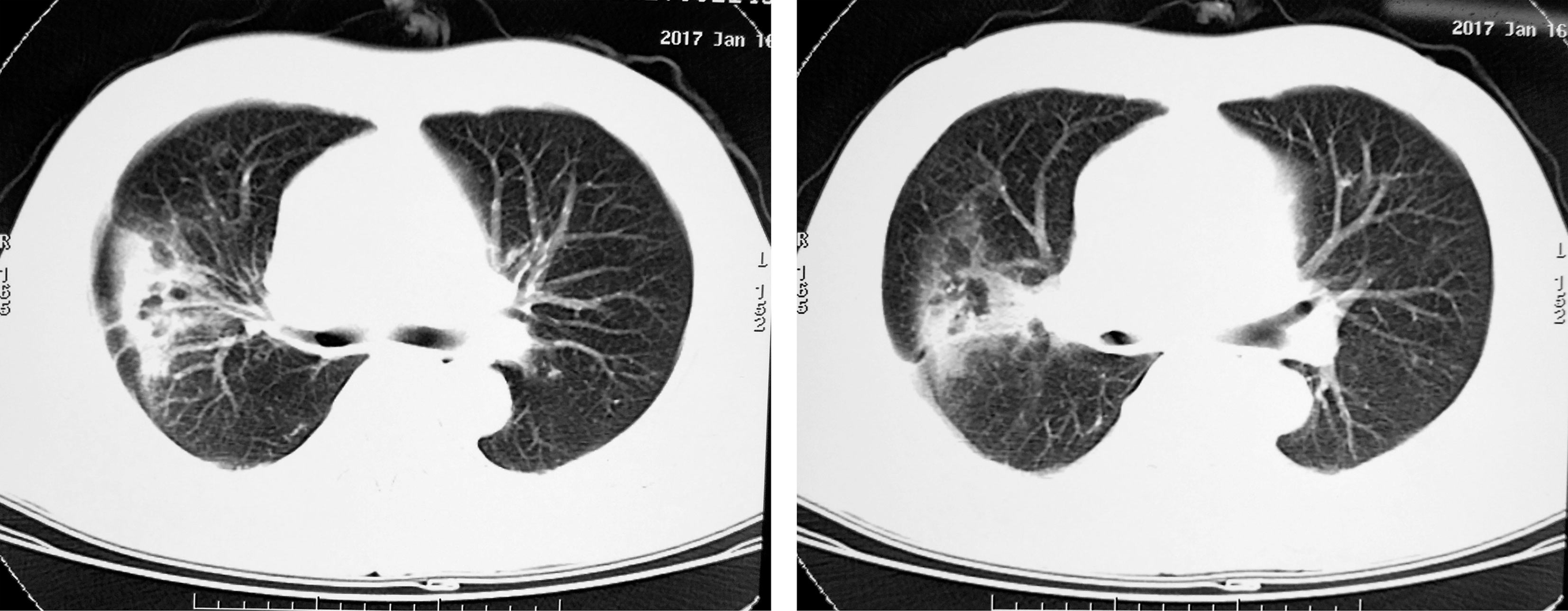 图14-7 2017年1月2日胸部ct 平扫:两肺斑片影,小结节影,结片