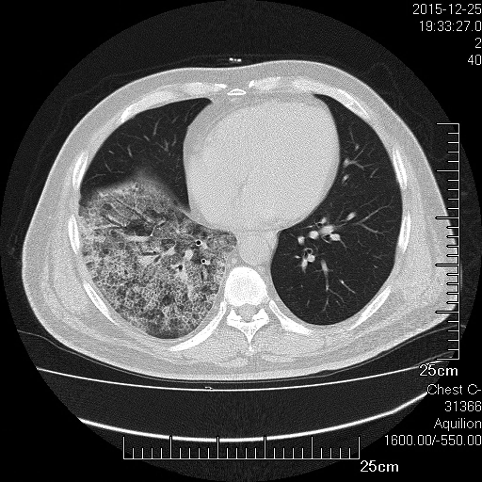 【影像学检查】          胸部ct(图2-4-3):示右下肺实变.
