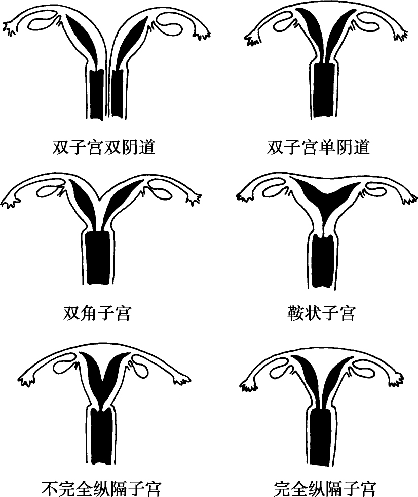 图1-12 发育不良的子宫形态