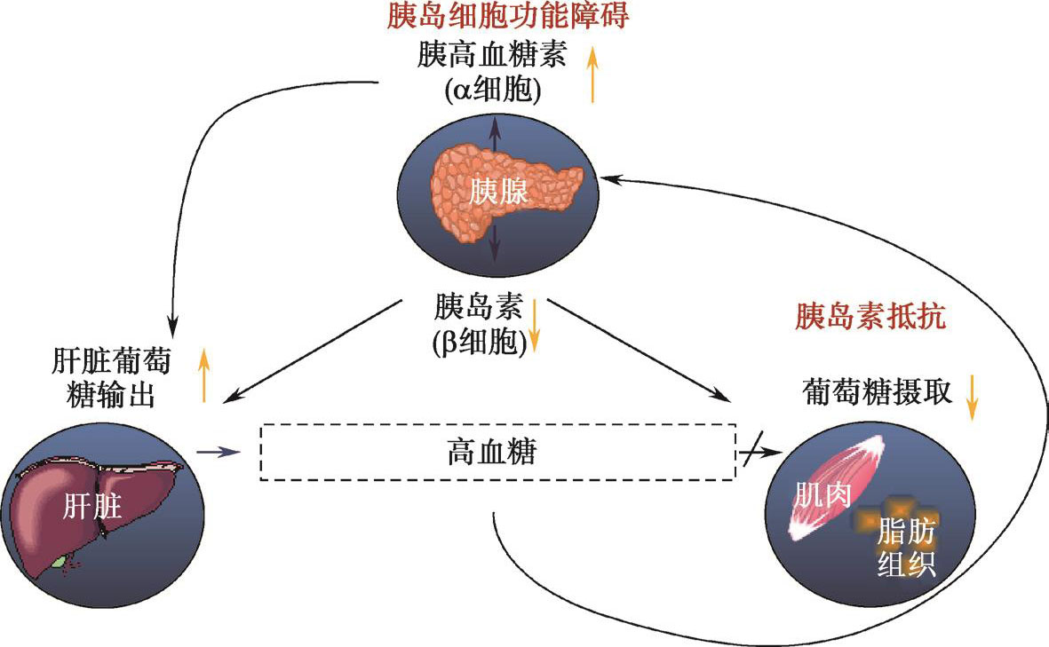 图2 2型糖尿病的主要病理生理缺陷