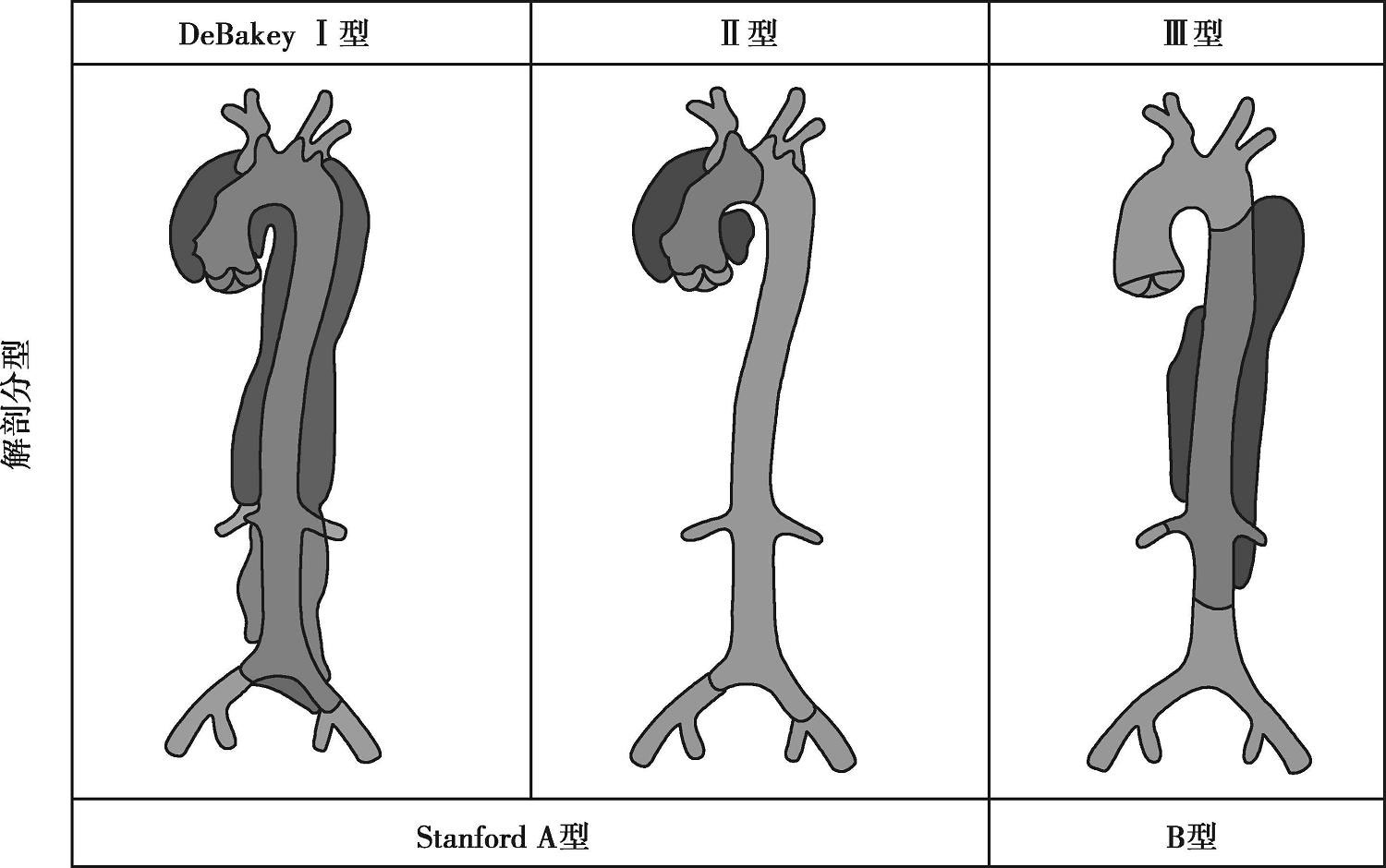 图6-1-1 主动脉夹层的debakey分型